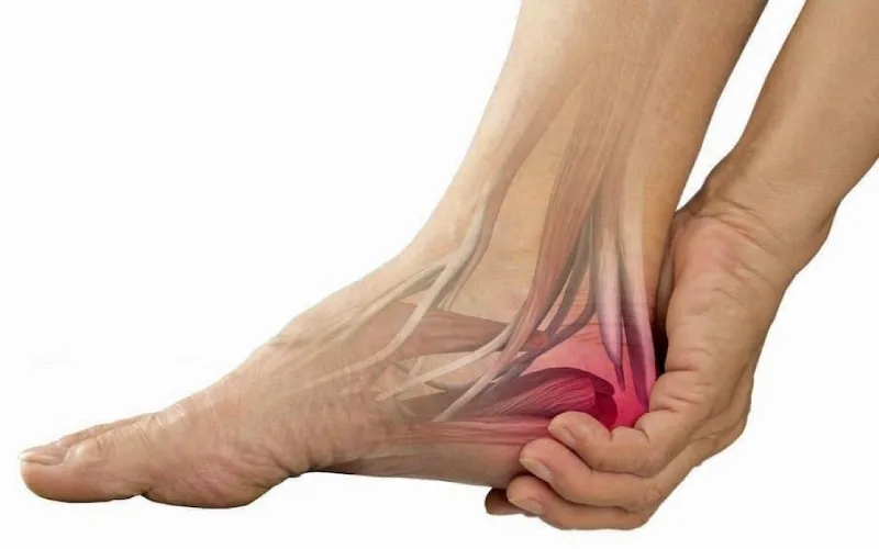 سبک زندگی در درمان خار پاشنه