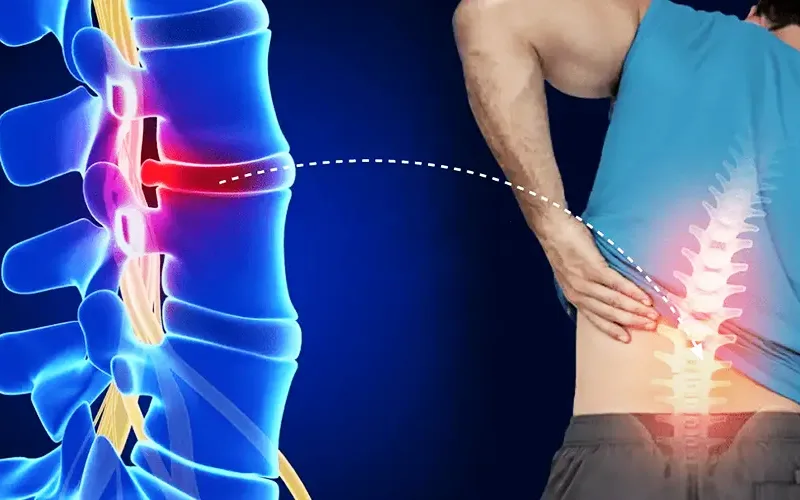 راه های پیشگیری از دیسک کمر