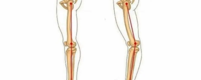 ۶ تمرین ورزشی برای اصلاح عقب زدگی زانو