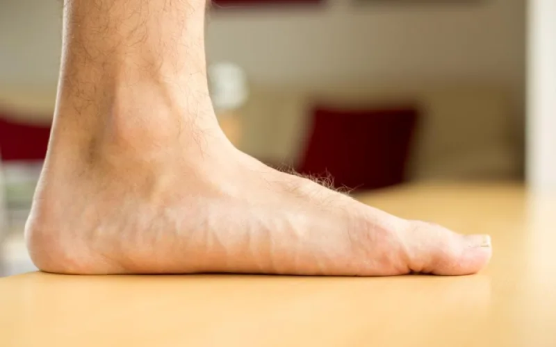 هزینه درمان کف پای صاف در بزرگسالان 