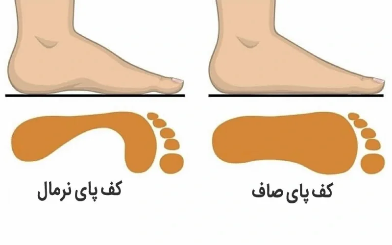 تشخیص کف پای صاف در بزرگسالان