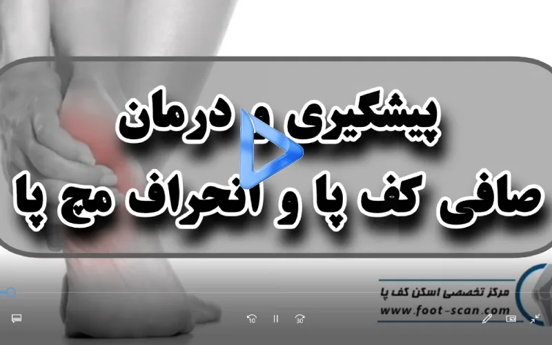 درمان صافی کف پا و انحراف مچ پا