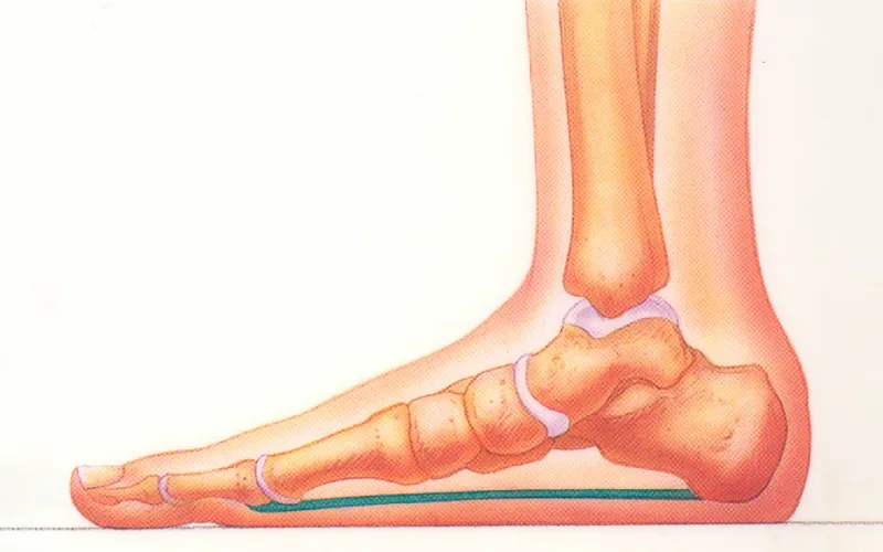 درمان کف پای صاف در بزرگسالان 