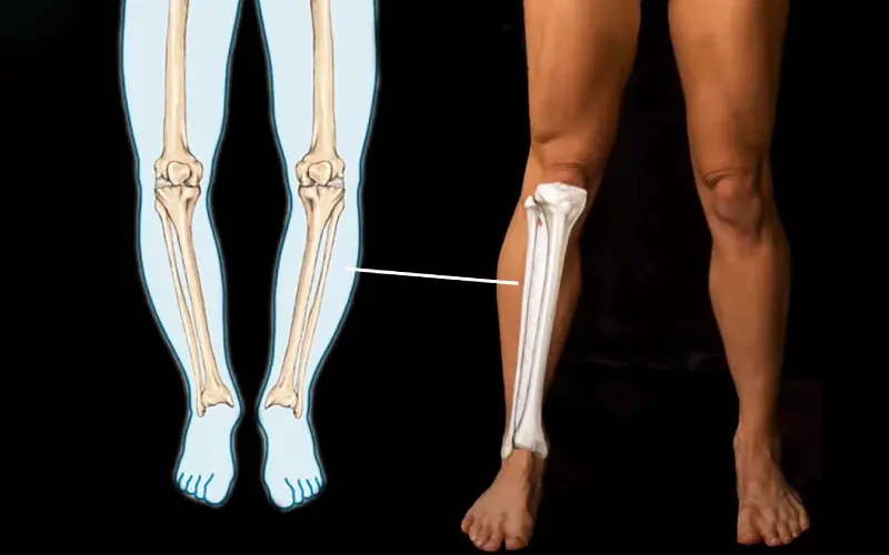 انحراف زانو چگونه تشخیص داده میشود