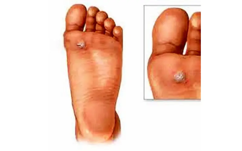 درمان فوری خارپاشنه