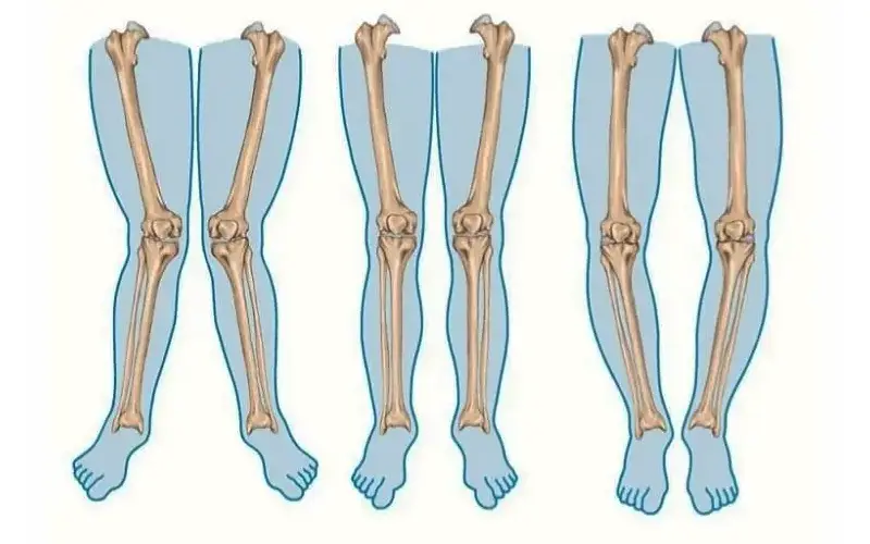 تست انحراف زانو