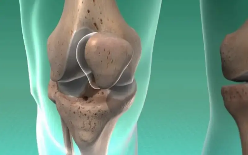 مهمترین دلایل اصلی انحراف زانو