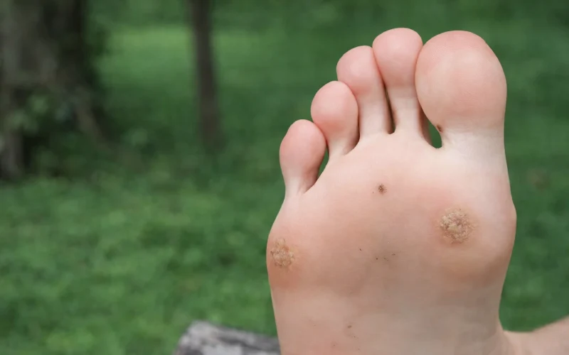 چگونه از ایجاد میخچه در پا پیشگیری کنیم؟