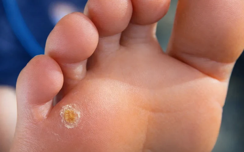 پیشگیری و درمان میخچه پا