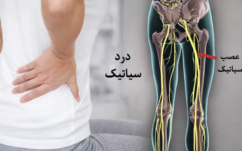 درد سیاتیک