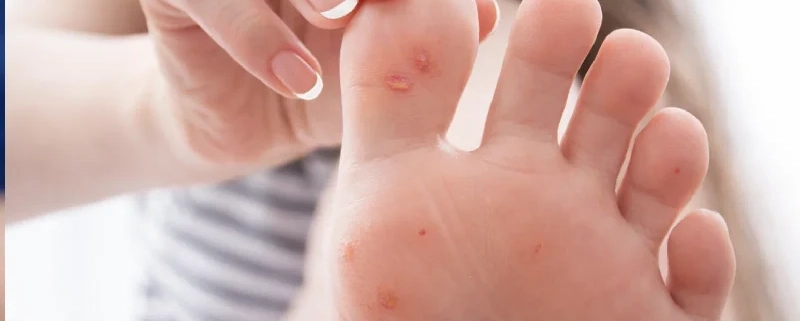 بهترین روش پیشگیری و درمان میخچه پا