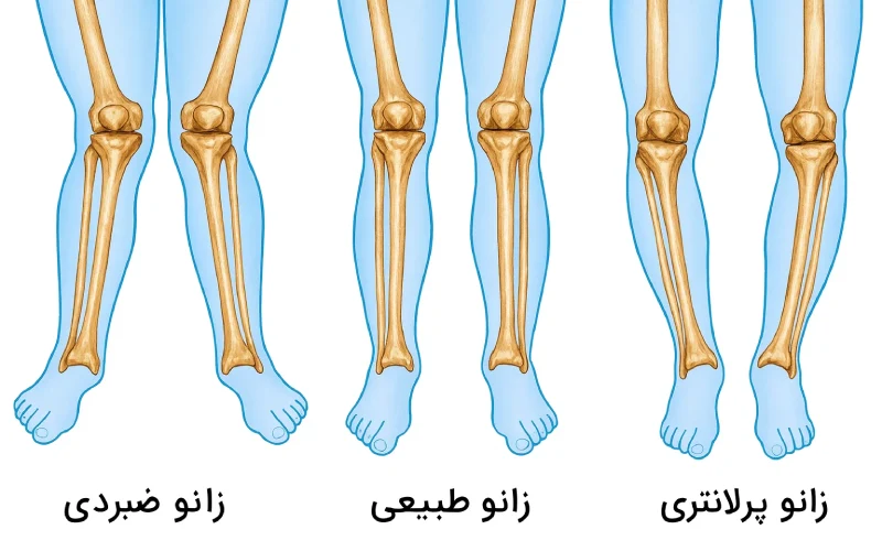 تفاوت اصلی زانوی پرانتزی و زانوی ضربدری