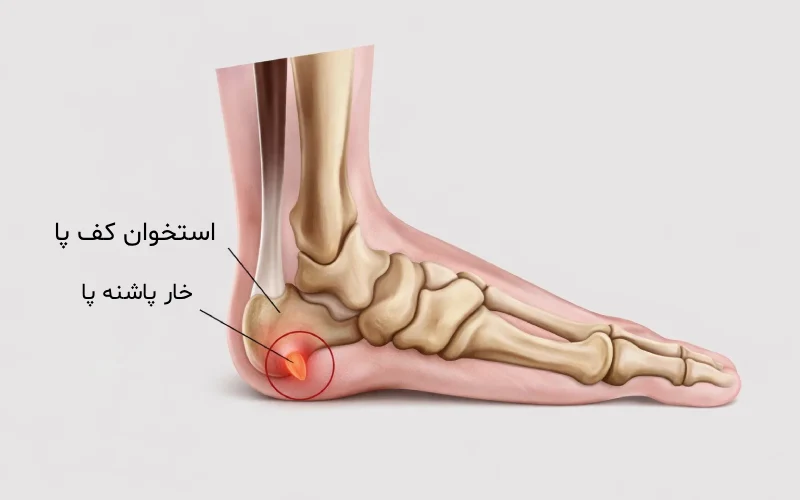 نشانه های خار پاشنه