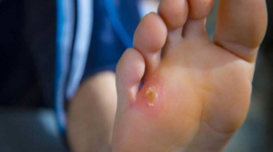 میخچه چیست